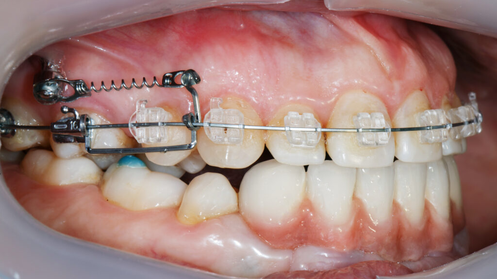 歯科矯正用アンカースクリューTAD（Temporary Anchorage Device）