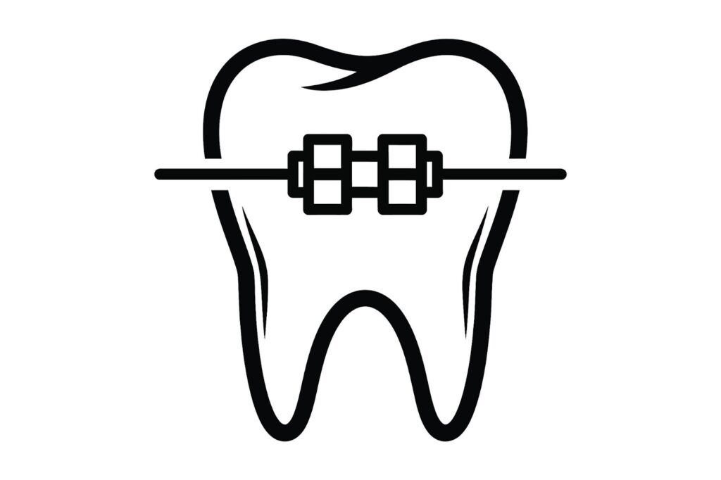 部分矯正 ワイヤー