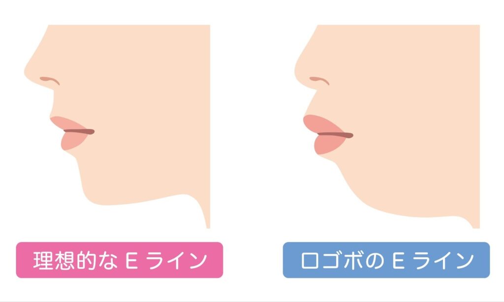 部分矯正 口ゴボ